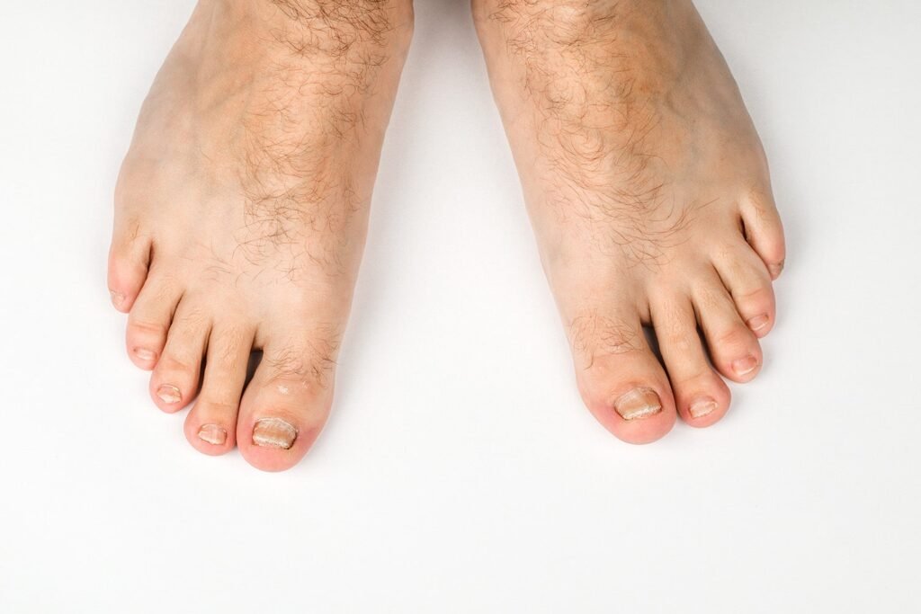 Lorsque vous avez un faible niveau de vitamine D, vous développerez une carence en calcium en un rien de temps. Avec un faible taux de calcium dans le sang, la structure de base des ongles est affectée. Dans ce cas, les ongles peuvent se ramollir, ou peuvent même se déformer dans des conditions graves. Le pelage et la fissuration des ongles peuvent aussi se produire en réponse à une carence en vitamine D.