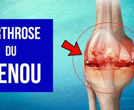 Produits NeoLife pour arthrose au Cameroun