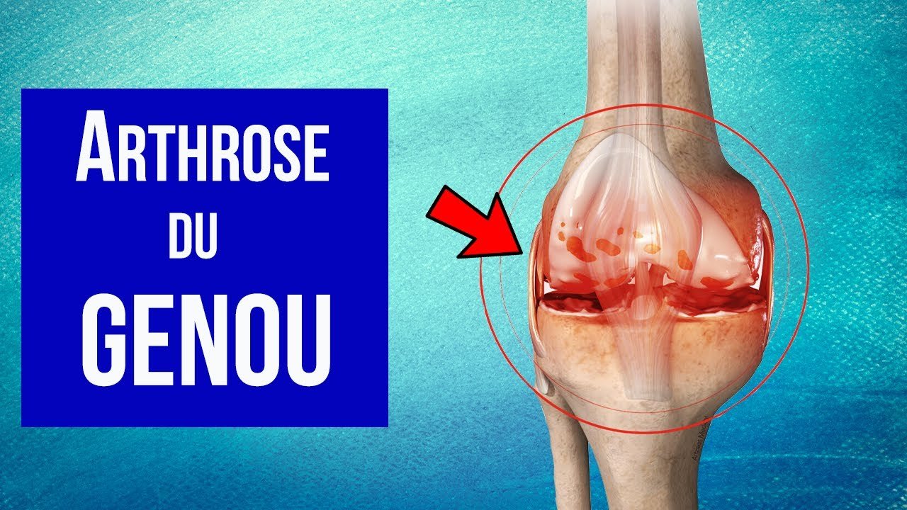Produits NeoLife pour arthrose au Cameroun